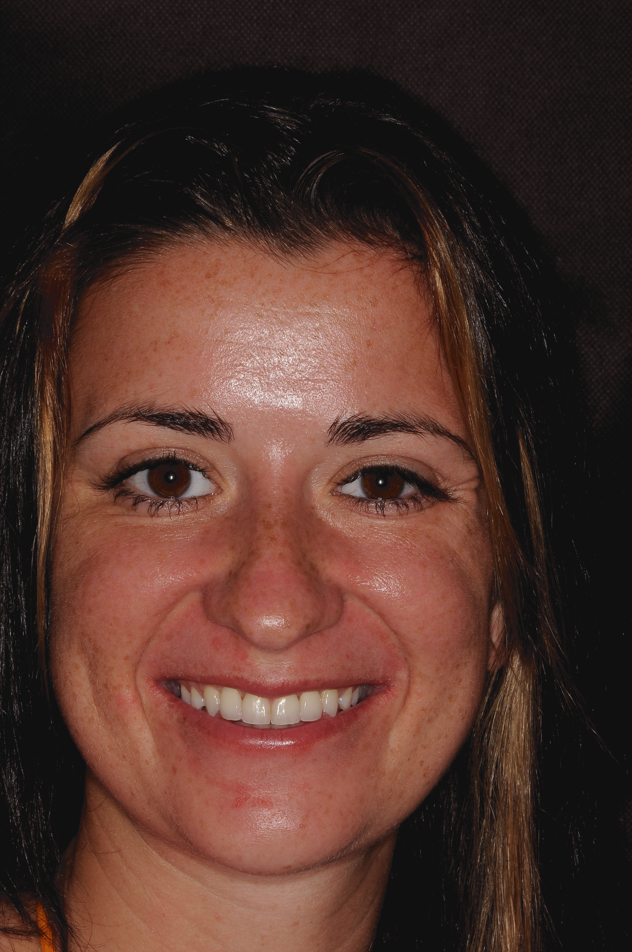 Patient with restored full smile after Dental Implants at Dentist Plant City