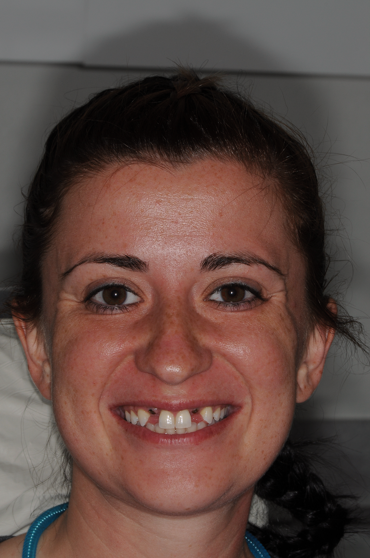 Patient with worn teeth before Dental Implants at Dentist Plant City