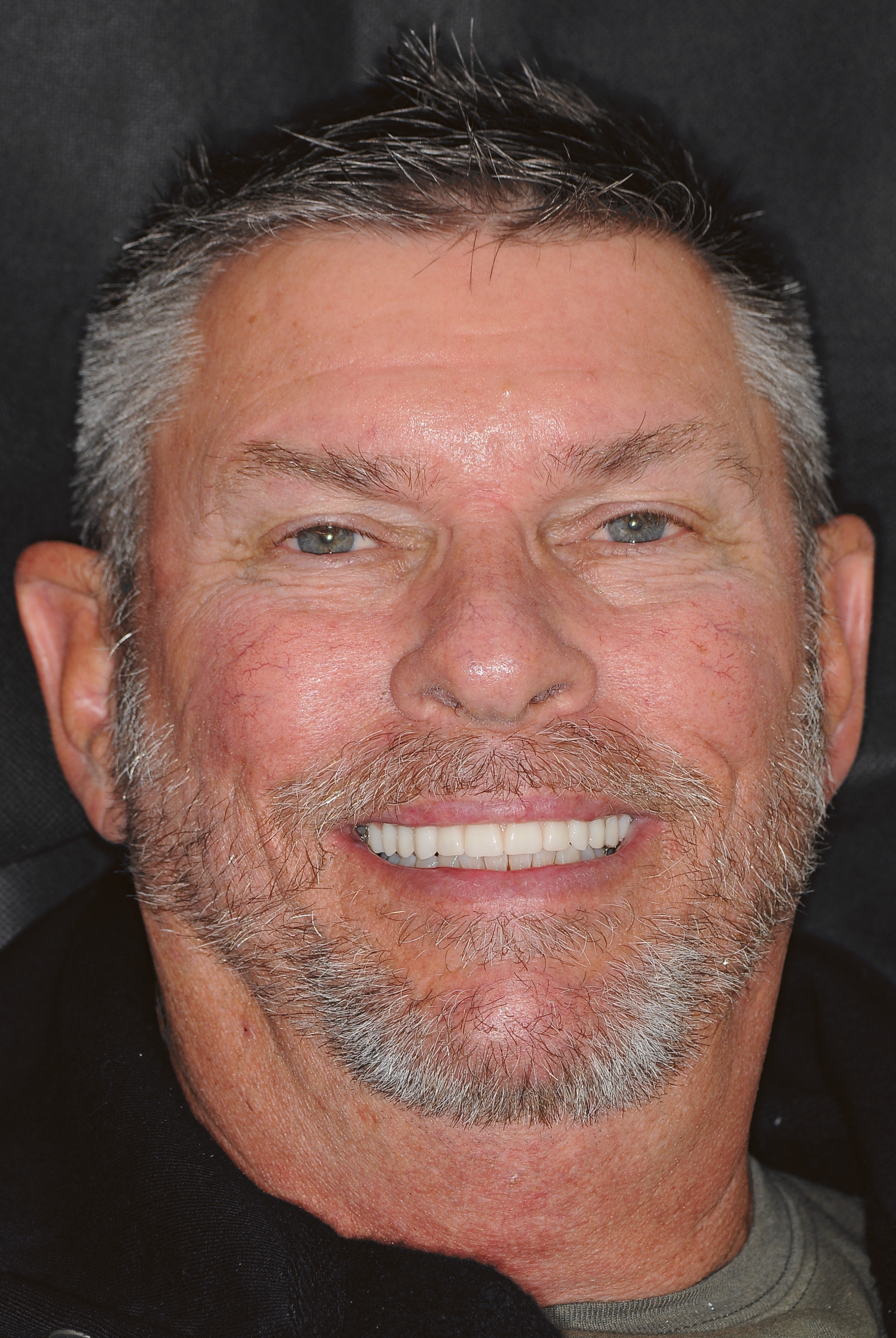 Patient with restored full smile after AOX treatment at Dentist Plant City