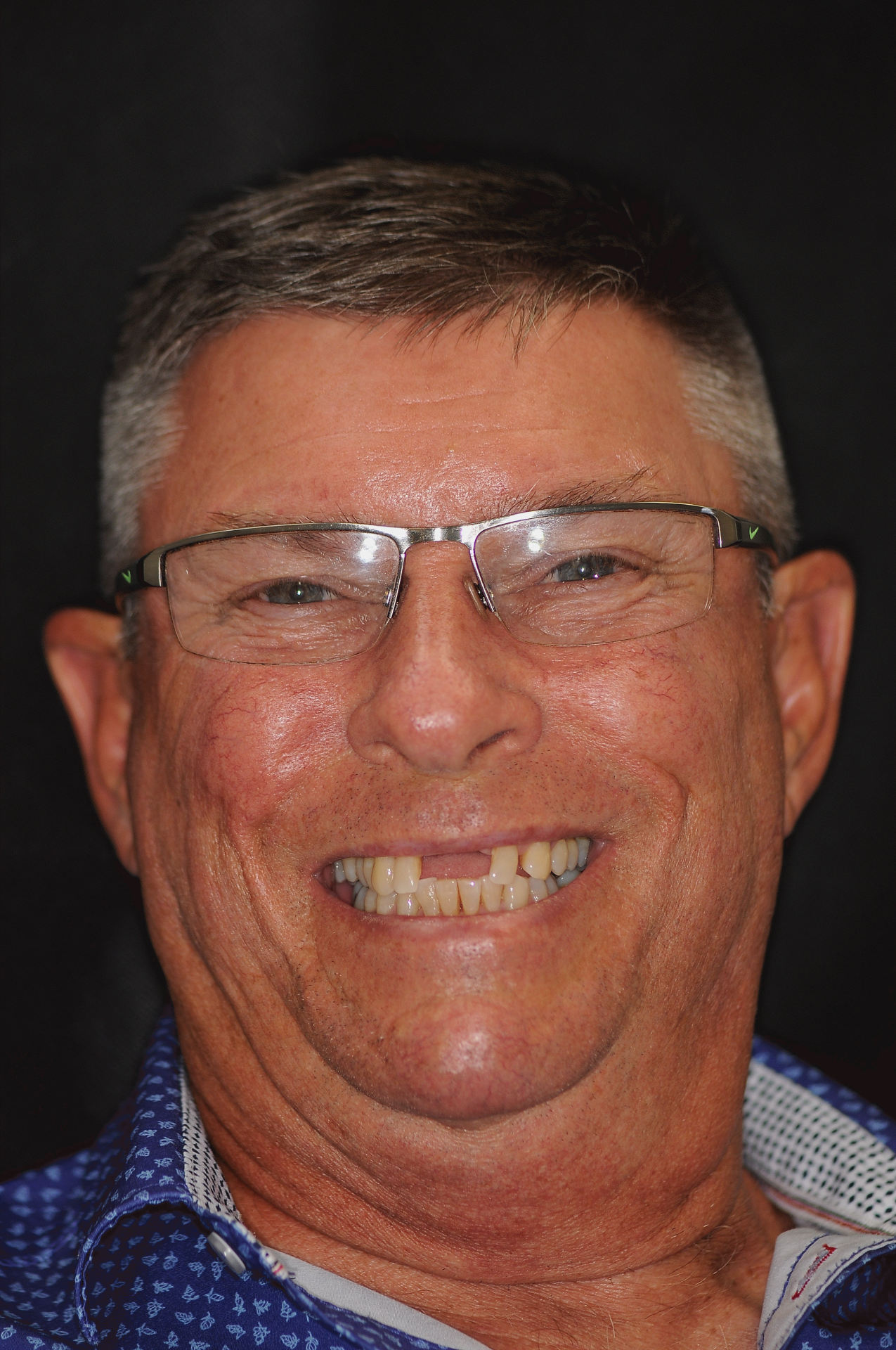 Patient with worn teeth before AOX treatment at Dentist Plant City