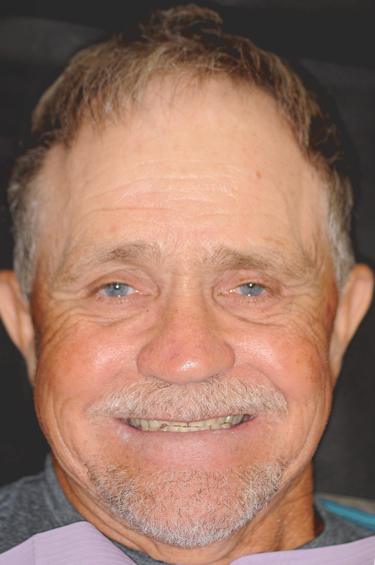 Patient with worn teeth before treatment at Dentist Plant City