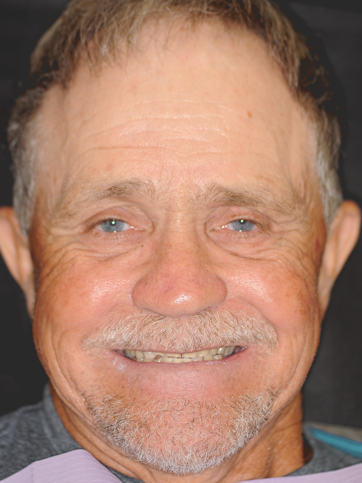 Patient with worn teeth before treatment at Dentist Plant City