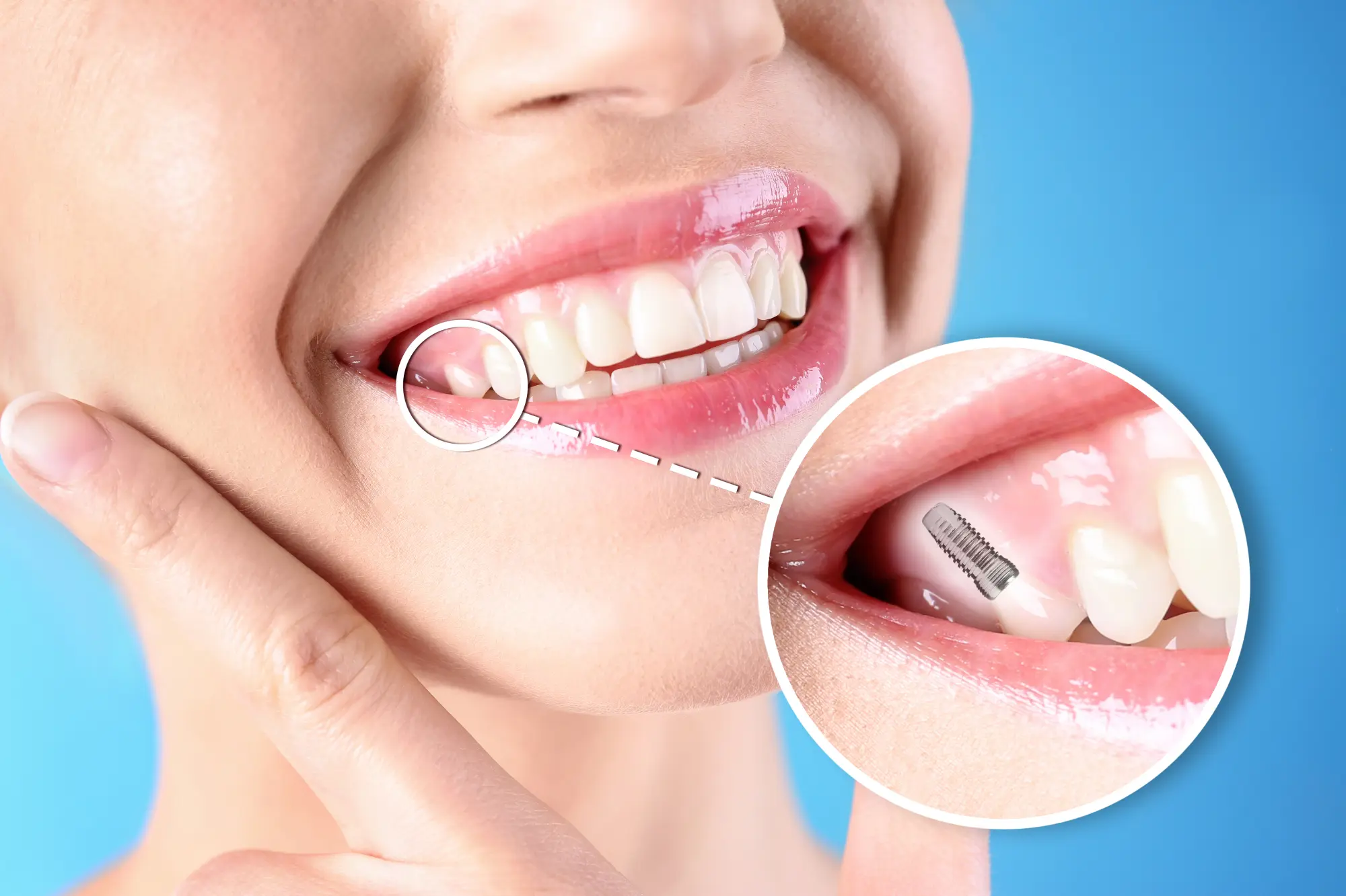 What’s the Best Solution When the Back Upper Jawbone Is Too Thin for Dental Implants?